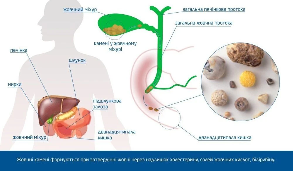 Які продукти розчиняють камені в жовчному міхурі: правда, міфи та реальні можливості